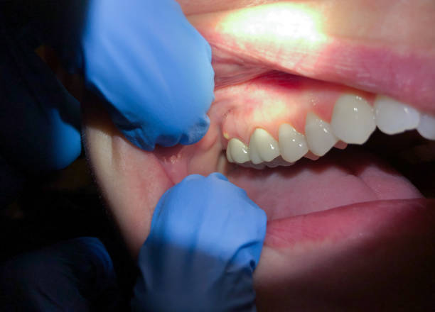 Best Emergency Wisdom Tooth Extraction in Dunnstown, PA